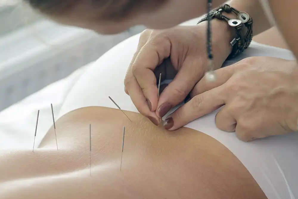 Acupuncture
