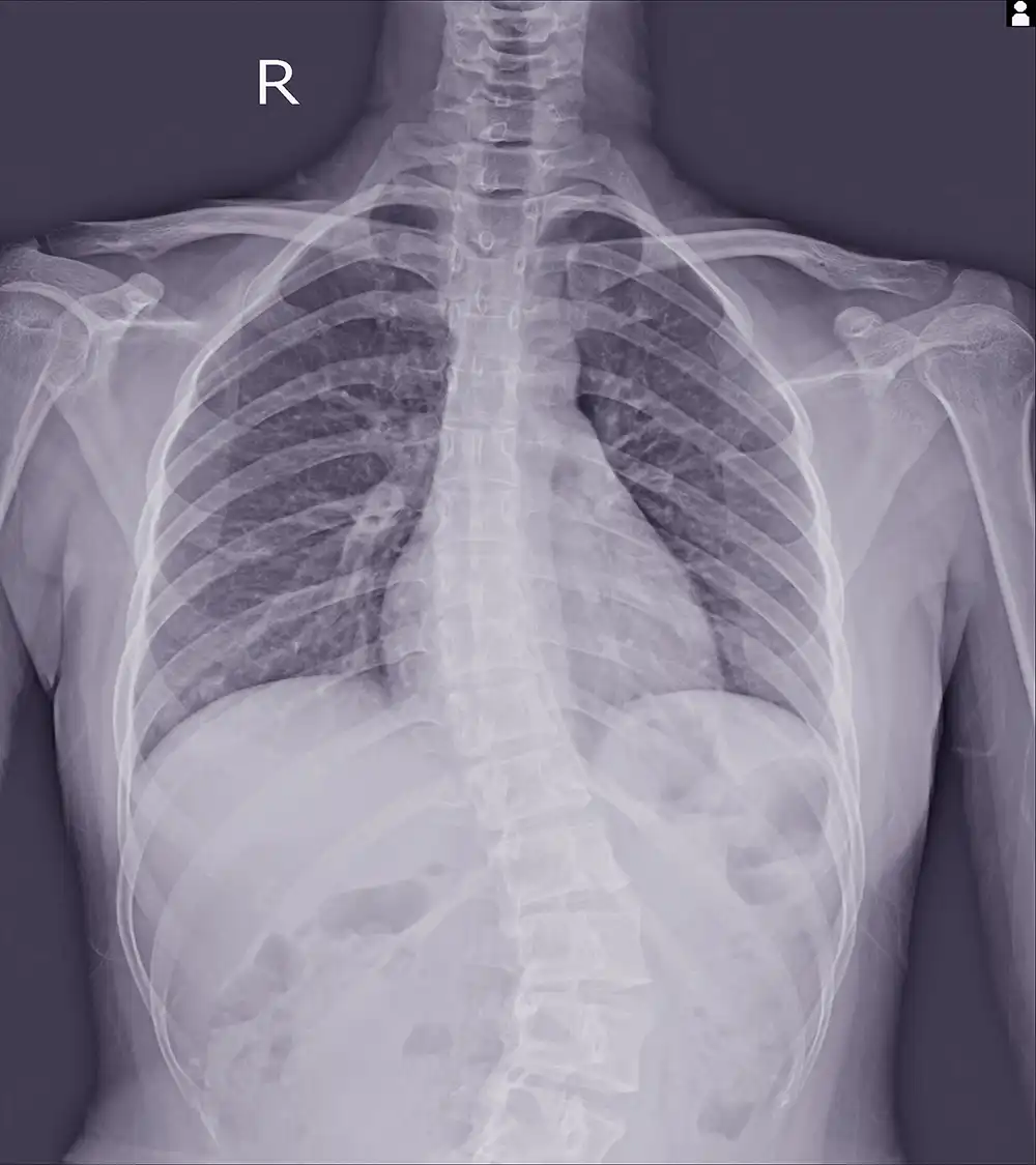 Scoliosis