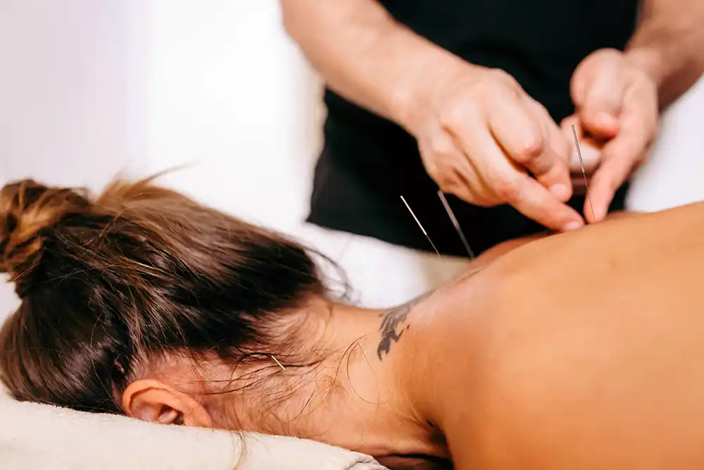 Close-up of dry needling on a patient's shoulder