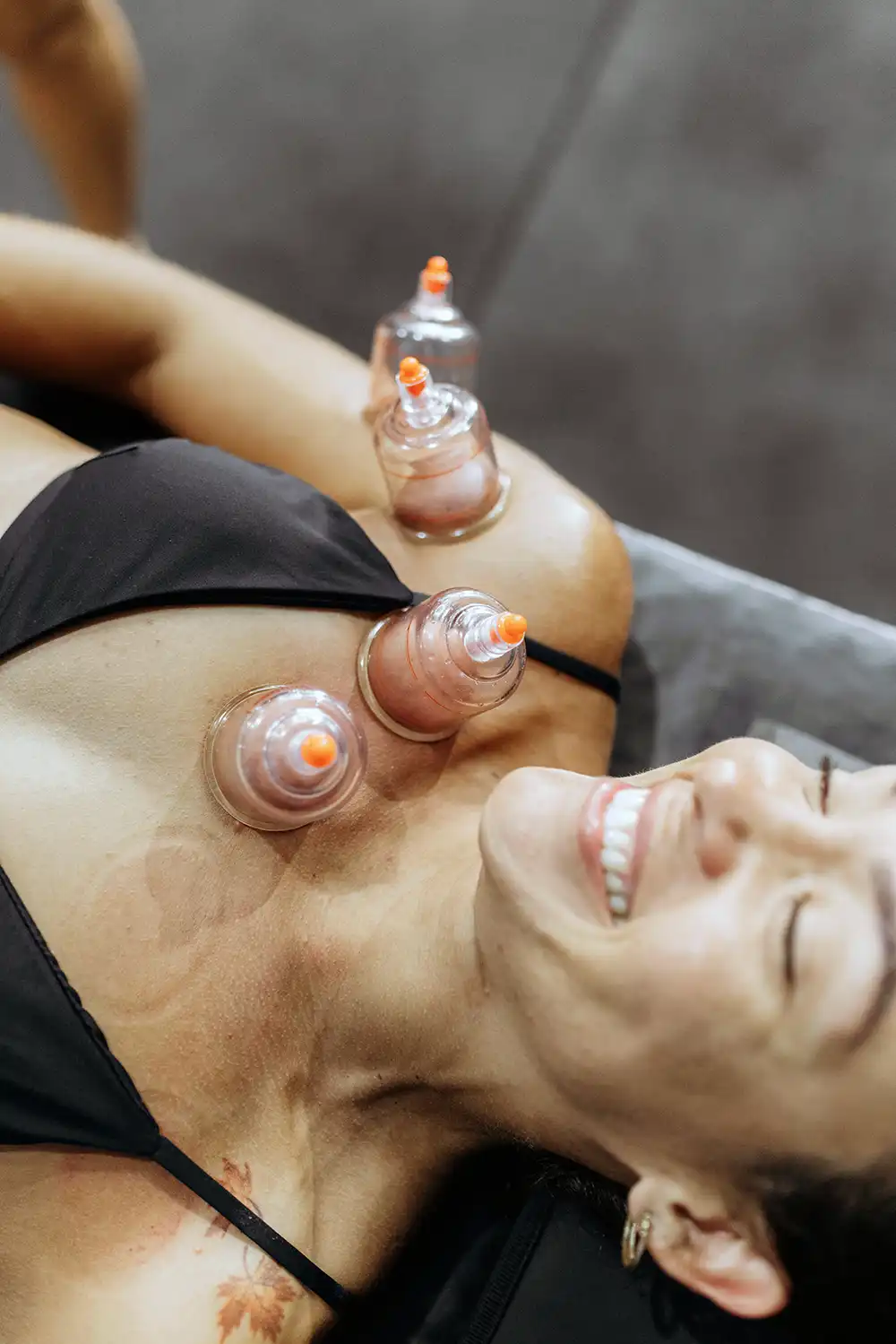 Therapist performing cupping therapy on a patient