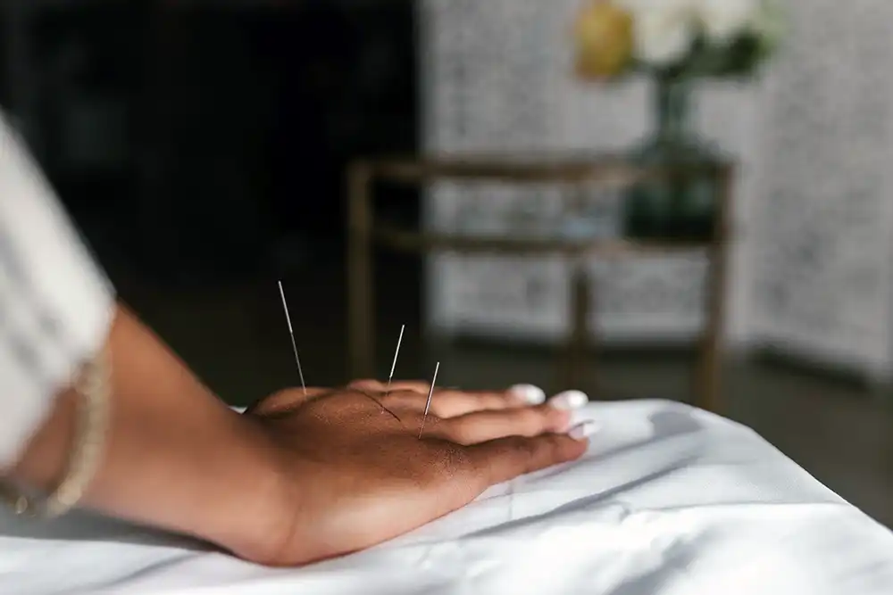 Dry Needling vs. Acupuncture